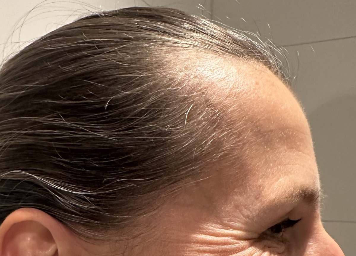 Geheimratsecken Frau: Schläfe mit zurückgehendem Haaransatz auf dem Vorher-Foto vom Mai 2025